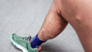 Close-up of a man's lower leg showing visible varicose veins, wearing a green athletic shoe on a gray floor.
