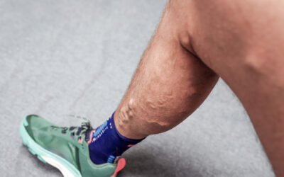 Men Get Varicose Veins Too