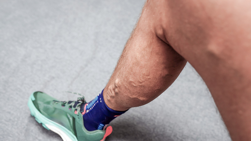 Close-up of a man's lower leg showing visible varicose veins, wearing a green athletic shoe on a gray floor.