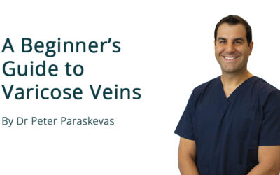 A Beginner’s Guide to Varicose Veins