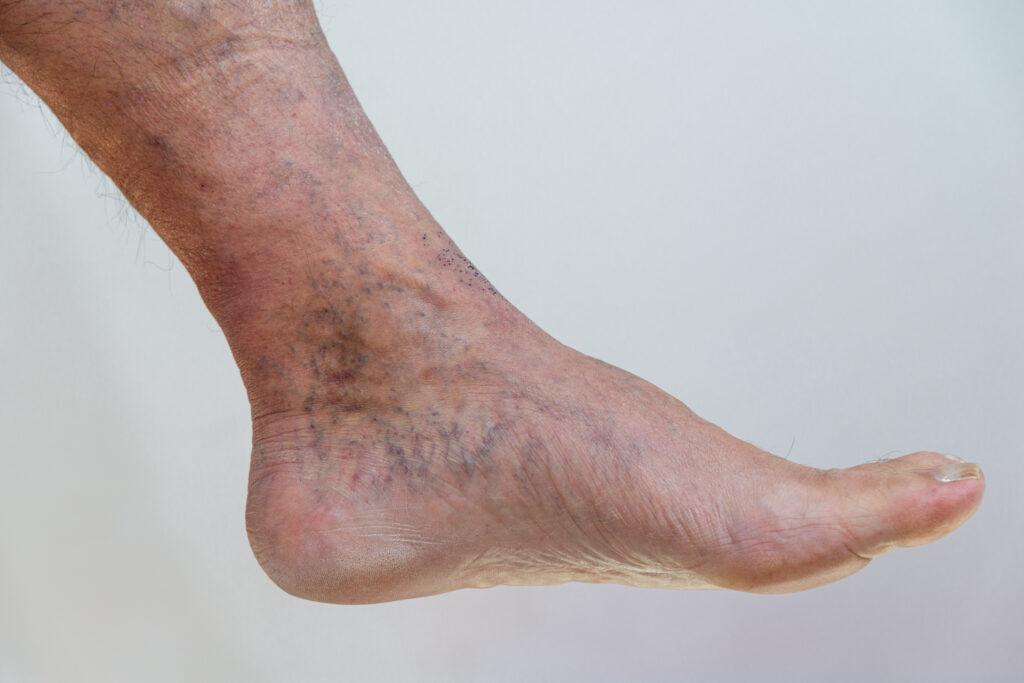 A close-up of a human foot and ankle displaying visible veins, skin discoloration, and some signs of swelling.