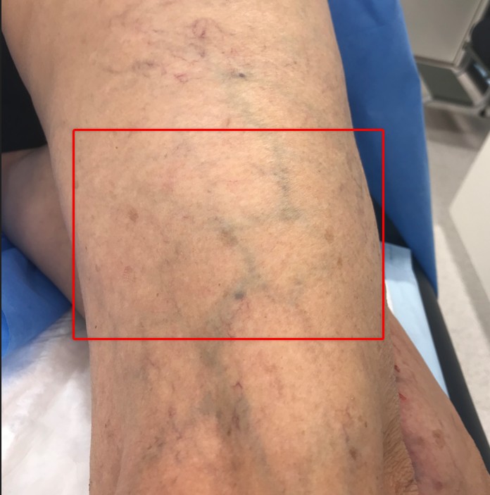 A thigh showing visible reticular or feeder veins highlighted in a red rectangle outline.